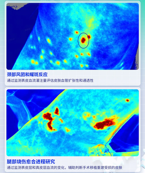瑞沃德激光散斑血流成像系统获批FDA认证