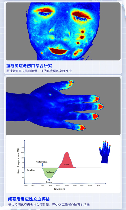 瑞沃德激光散斑血流成像系统获批FDA认证